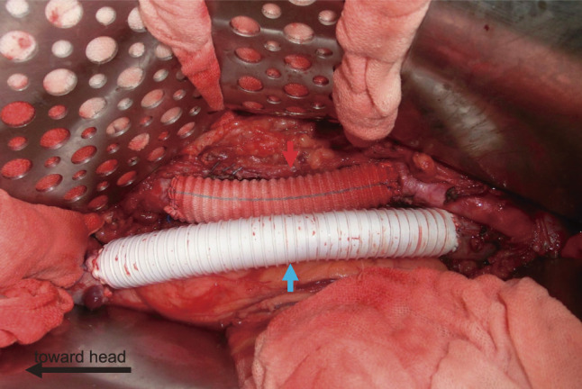 The Role of Cardiovascular Surgeons in Oncovascular Surgery for Resection of Retroperitoneal Tumors: A Case Report.