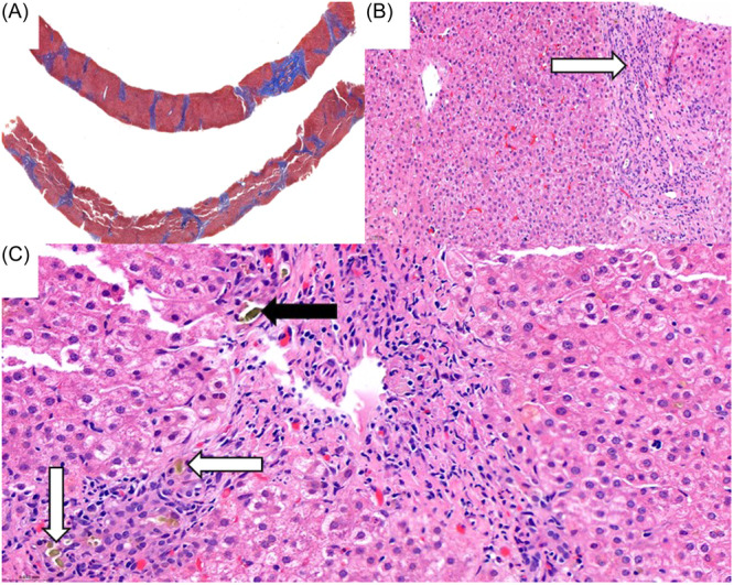A novel genetic variant associated with progressive familial intrahepatic cholestasis type 3: A case series.