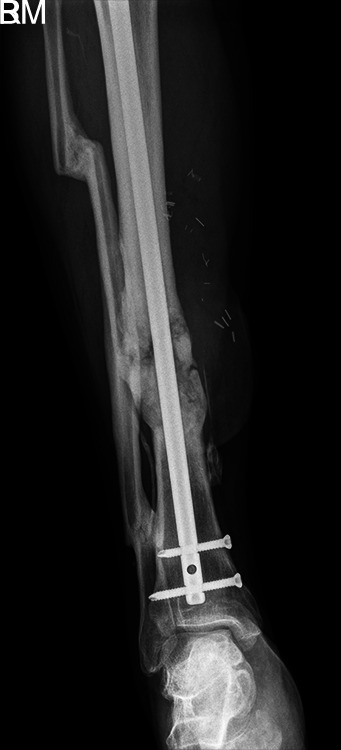 A Novel Technique to Remove a Tibial Nail.