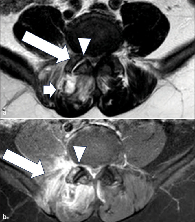 Facet joint septic arthritis: A review of cases.
