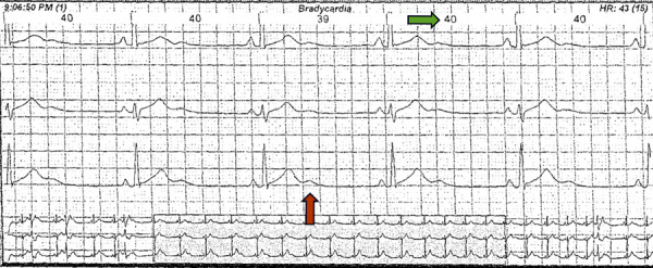 [Andersen-Tawil Syndrome, a differential of bidirectional ventricular tachycardia: a case report].