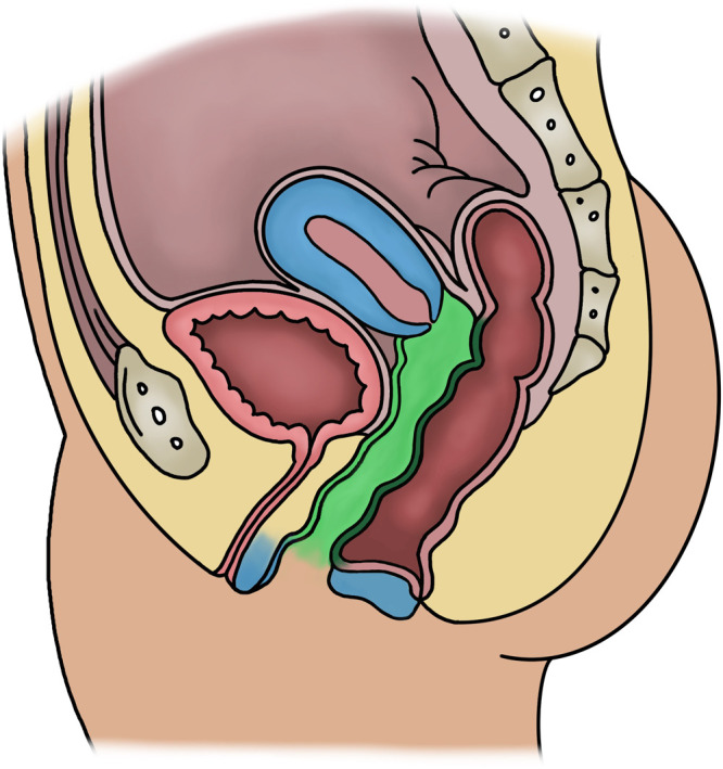 Creation of a Neovagina with Single Staged Uterine Anastomosis.