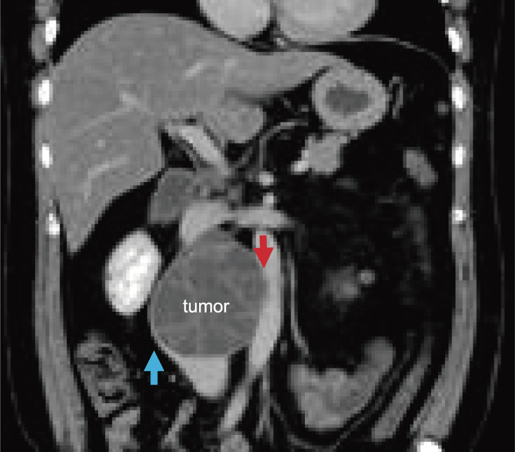 The Role of Cardiovascular Surgeons in Oncovascular Surgery for Resection of Retroperitoneal Tumors: A Case Report.