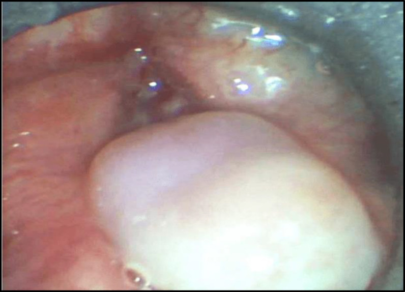 Junctional Epidermolysis Bullosa Associated Laryngeal Stenosis: A Case Report and Review of Literature.