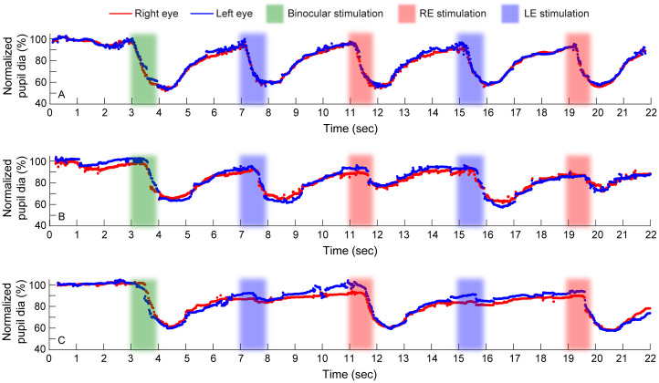 Diagnostic accuracy of a modularized, virtual-reality-based automated pupillometer for detection of relative afferent pupillary defect in unilateral optic neuropathies.
