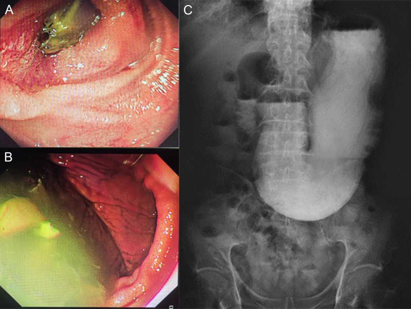 EUS-led breakthrough: An innovative journey to overcome complete gastric outlet obstruction by gastroenterostomy (with video).