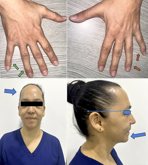 [Andersen-Tawil Syndrome, a differential of bidirectional ventricular tachycardia: a case report].