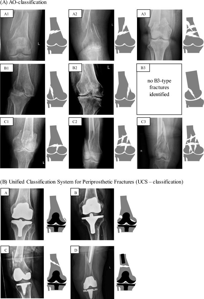 Distal femoral fractures: periprosthetic fractures have four times more complications than non-periprosthetic fractures and cerclage should be avoided: retrospective analysis of 206 patients.