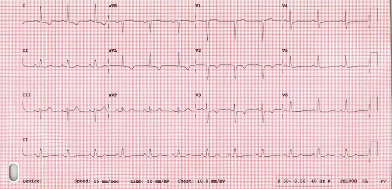 Unrecognized Inter-Coronary Communication in a Case of Hypertrophic Cardiomyopathy.