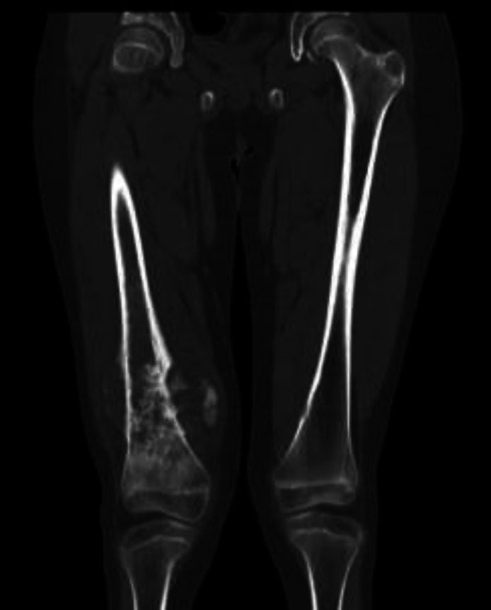 Ifosfamide-induced nephrogenic diabetes insipidus and Fanconi syndrome in a patient with femur osteosarcoma.