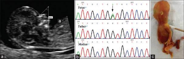 First-trimester Diagnosis of Micrognathia as a Presentation of Stickler Syndrome.