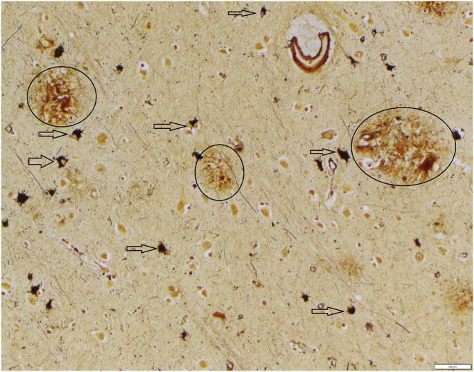 Alzheimer disease-like neuropathologic changes in a geriatric baboon (<i>Papio hamadryas</i>).