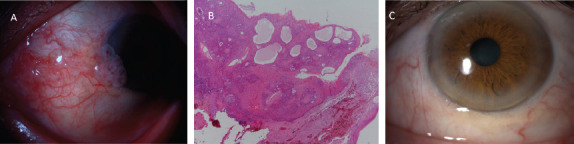 Ocular Surface Squamous Neoplasia in Renal Transplant Patients.