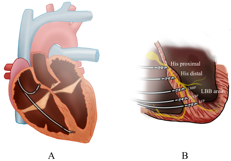 Review of Atrioventricular Node Ablation Combined with Permanent His-Purkinje Conduction System Pacing in Patients with Atrial Fibrillation with Heart Failure.