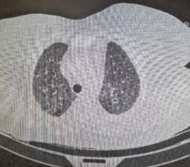 COVID-19 associated lung cavitary lesions: A case series.