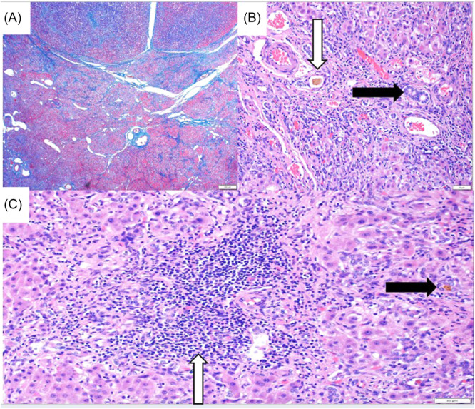 A novel genetic variant associated with progressive familial intrahepatic cholestasis type 3: A case series.