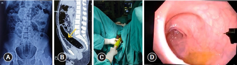 Minimally invasive techniques as adjuncts in low- versus high-lying retained rectal foreign bodies of autoerotic nature in young men: a tailored management algorithm with two contrasting case reports from India.