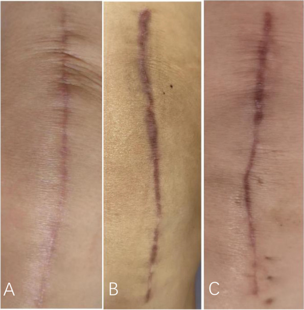 Comparison of the safety and efficacy of three superficial skin closure methods for multi-layer wound closure in total knee arthroplasty: a multicenter, prospective, randomized controlled trial.