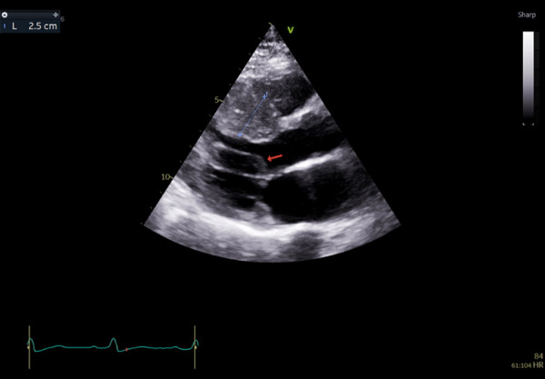 Unrecognized Inter-Coronary Communication in a Case of Hypertrophic Cardiomyopathy.