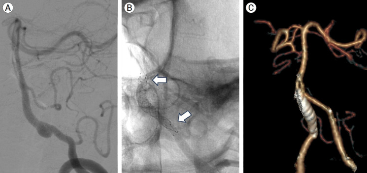Multiple telescopic stenting versus single flow diverter for the treatment of vertebral artery dissecting aneurysm.