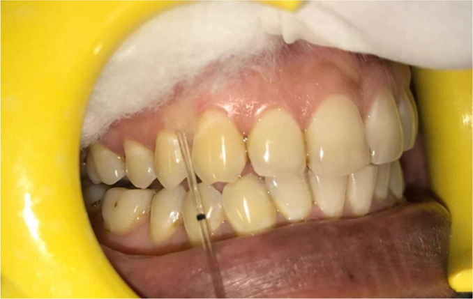 Comparative evaluation of serum and gingival crevicular fluid levels of interleukin 21 in periodontally diseased and healthy patients.