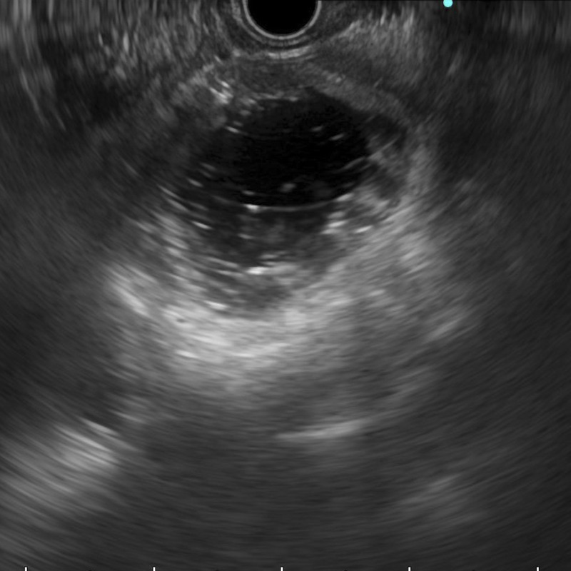 Recurrence of malignant duodenal obstruction following duodenal stenting: successful management through EUS-guided gastrojejunostomy (with videos).