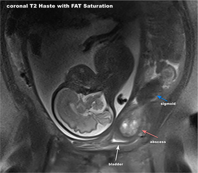 Complicated diverticulitis with colovesical fistula and bladder abscess formation in pregnancy: a case report.