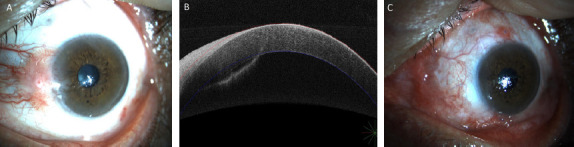 Ocular Surface Squamous Neoplasia in Renal Transplant Patients.