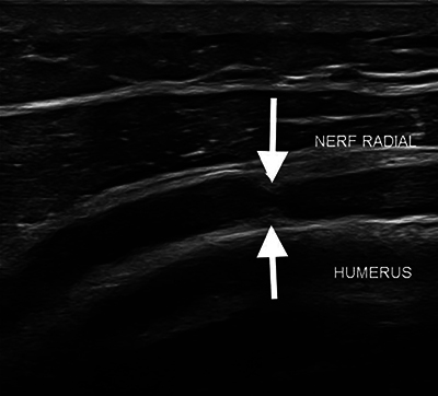 Hourglass Constrictive Neuropathy: A Likely Underdiagnosed Condition with Characteristic Imaging Features.