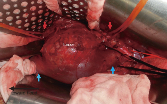 The Role of Cardiovascular Surgeons in Oncovascular Surgery for Resection of Retroperitoneal Tumors: A Case Report.