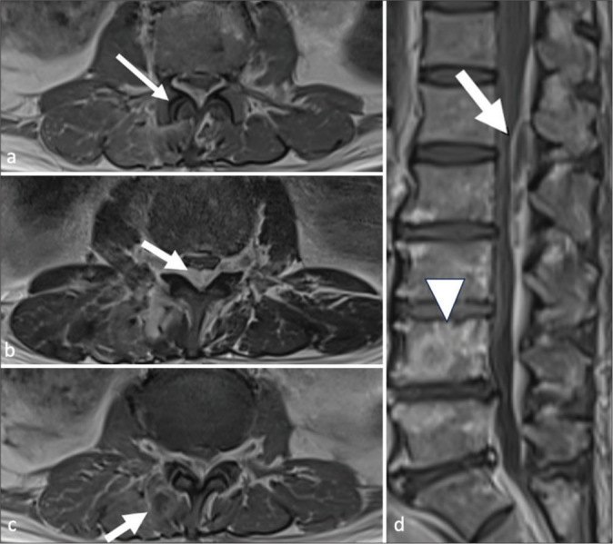 Facet joint septic arthritis: A review of cases.