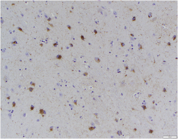 Alzheimer disease-like neuropathologic changes in a geriatric baboon (<i>Papio hamadryas</i>).