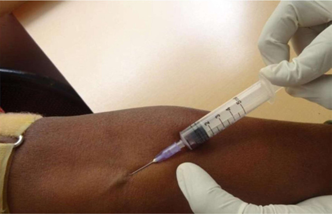 Comparative evaluation of serum and gingival crevicular fluid levels of interleukin 21 in periodontally diseased and healthy patients.