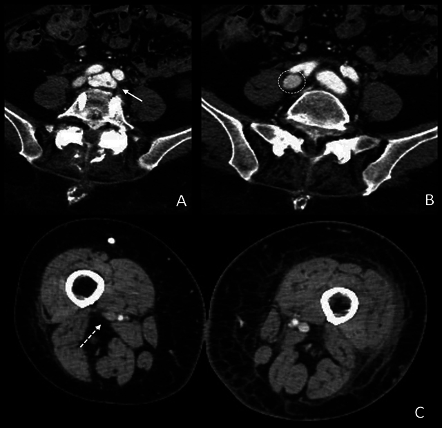 Arteriovenous Fistula Simulating Deep Vein Thrombosis Following Lumbar Arthrodesis.