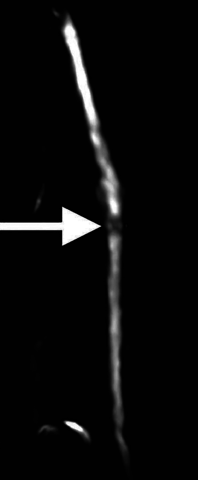 Hourglass Constrictive Neuropathy: A Likely Underdiagnosed Condition with Characteristic Imaging Features.
