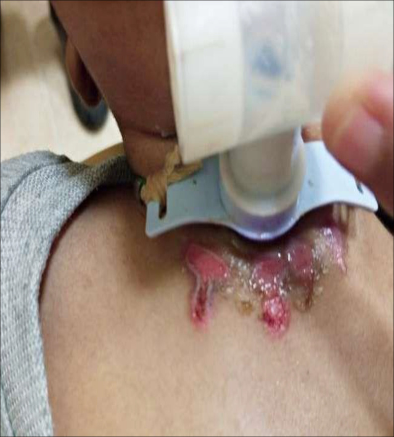 Junctional Epidermolysis Bullosa Associated Laryngeal Stenosis: A Case Report and Review of Literature.