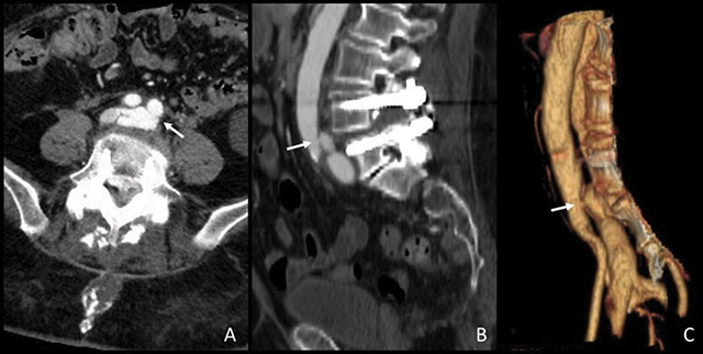 Arteriovenous Fistula Simulating Deep Vein Thrombosis Following Lumbar Arthrodesis.