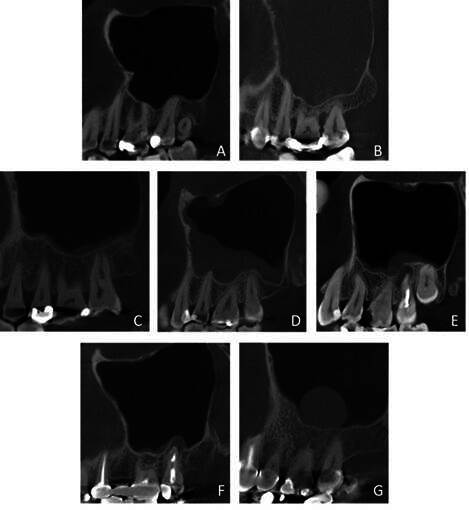 The relation between Schneiderian membrane thickening and radiodiagnostic features of periapical pathology.