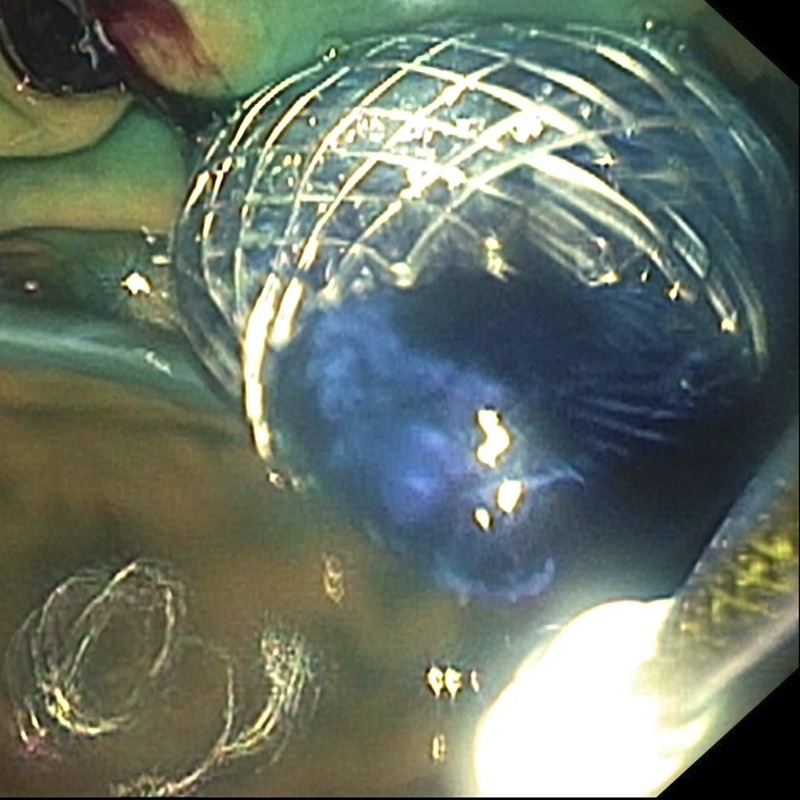 Recurrence of malignant duodenal obstruction following duodenal stenting: successful management through EUS-guided gastrojejunostomy (with videos).