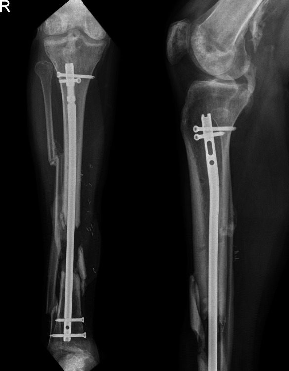 A Novel Technique to Remove a Tibial Nail.