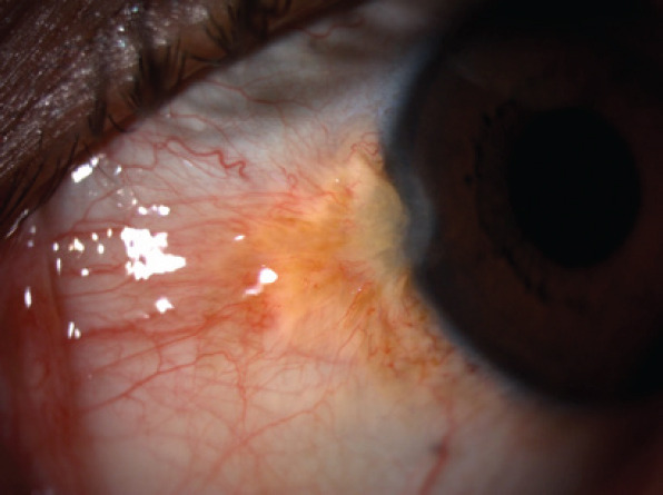 Ocular Surface Squamous Neoplasia in Renal Transplant Patients.