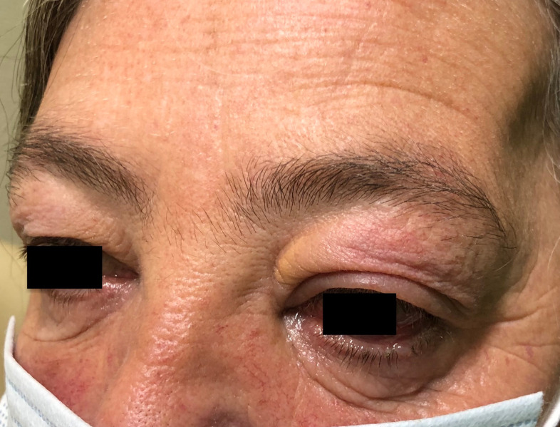Orbital Masses in Granulomatosis with Polyangiitis: A Call for Clinical Vigilance.