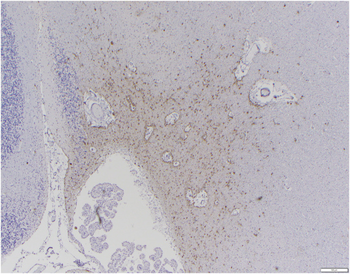 Alzheimer disease-like neuropathologic changes in a geriatric baboon (<i>Papio hamadryas</i>).