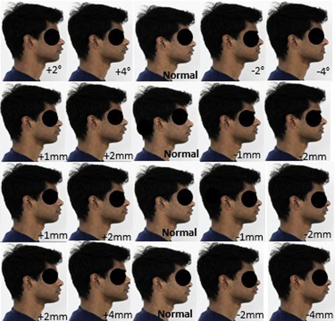 Esthetic preferences of orthodontists, general dentists, and laypersons for Indian facial profiles: A cross-sectional study.