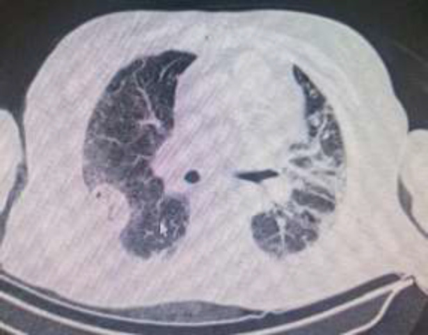 COVID-19 associated lung cavitary lesions: A case series.
