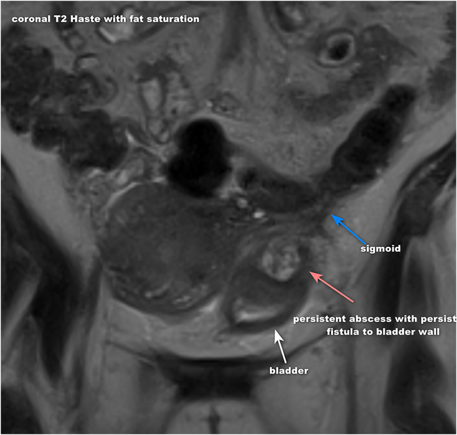 Complicated diverticulitis with colovesical fistula and bladder abscess formation in pregnancy: a case report.