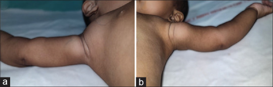 Systemic artery aneurysms - A marker of high-risk Kawasaki disease.