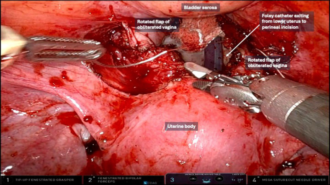 Creation of a Neovagina with Single Staged Uterine Anastomosis.