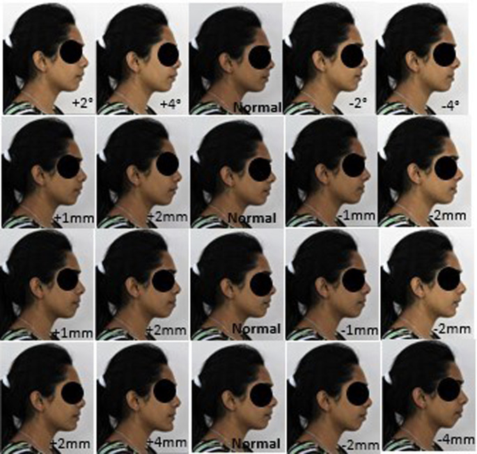 Esthetic preferences of orthodontists, general dentists, and laypersons for Indian facial profiles: A cross-sectional study.