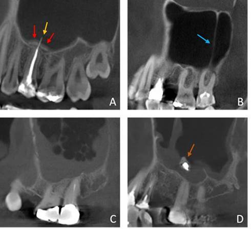 The relation between Schneiderian membrane thickening and radiodiagnostic features of periapical pathology.